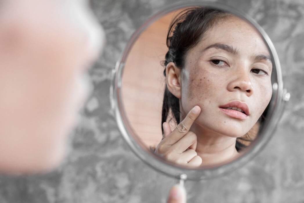 Mujer revisando en un espejo de mano las manchas de melasma en su mejilla
