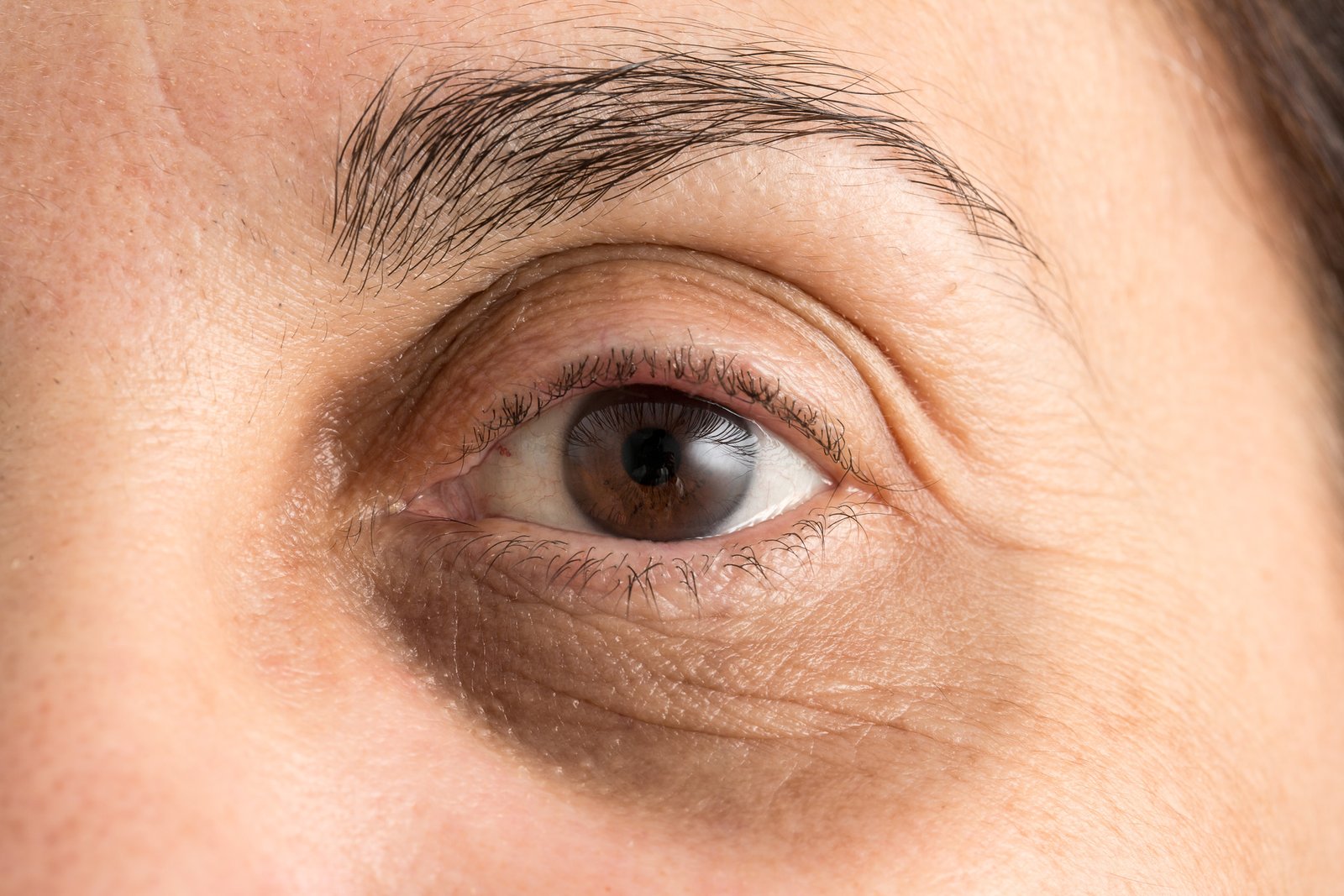 Primer plano de un ojo con ojera oscura y surco marcado bajo el párpado