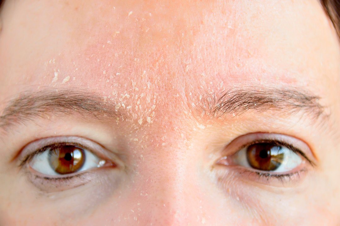¿Cuáles son las causas de la dermatitis seborreica? · imagen 1