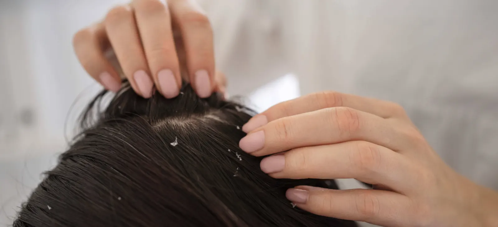 Descamamiento cuero cabelludo · ¿Cuáles son las causas de la dermatitis seborreica?