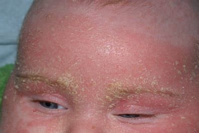 Seborrheic dermatitisTN mini · ¿Cuáles son las causas de la dermatitis seborreica?