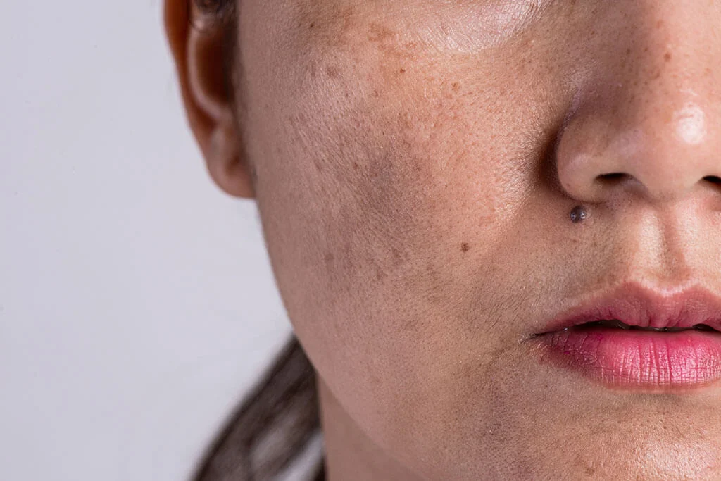 Primer plano del rostro de una mujer con manchas oscuras en mejilla y zona cercana a la nariz