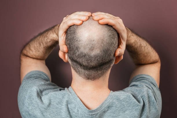 Hombre de espaldas con pérdida de cabello en la coronilla por alopecia androgénica