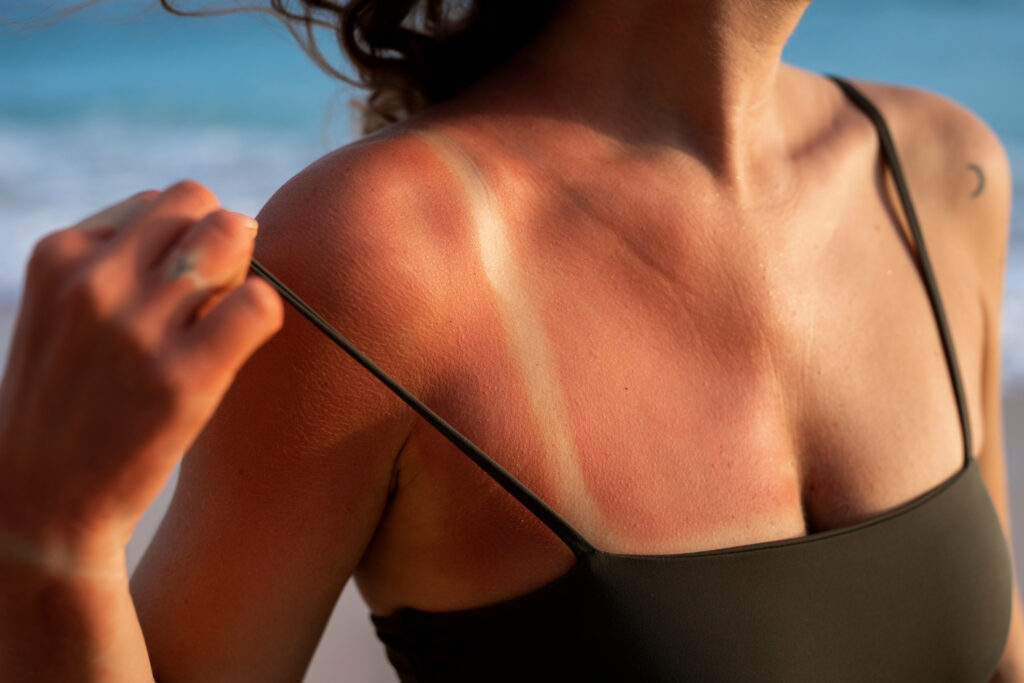 La alergia al sol en mujeres puede aparecer en el cuello, escote o cara