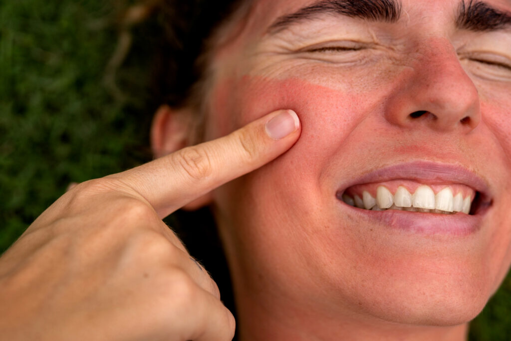 mujer con un alergia al sol en el rostro reacciona al tacto