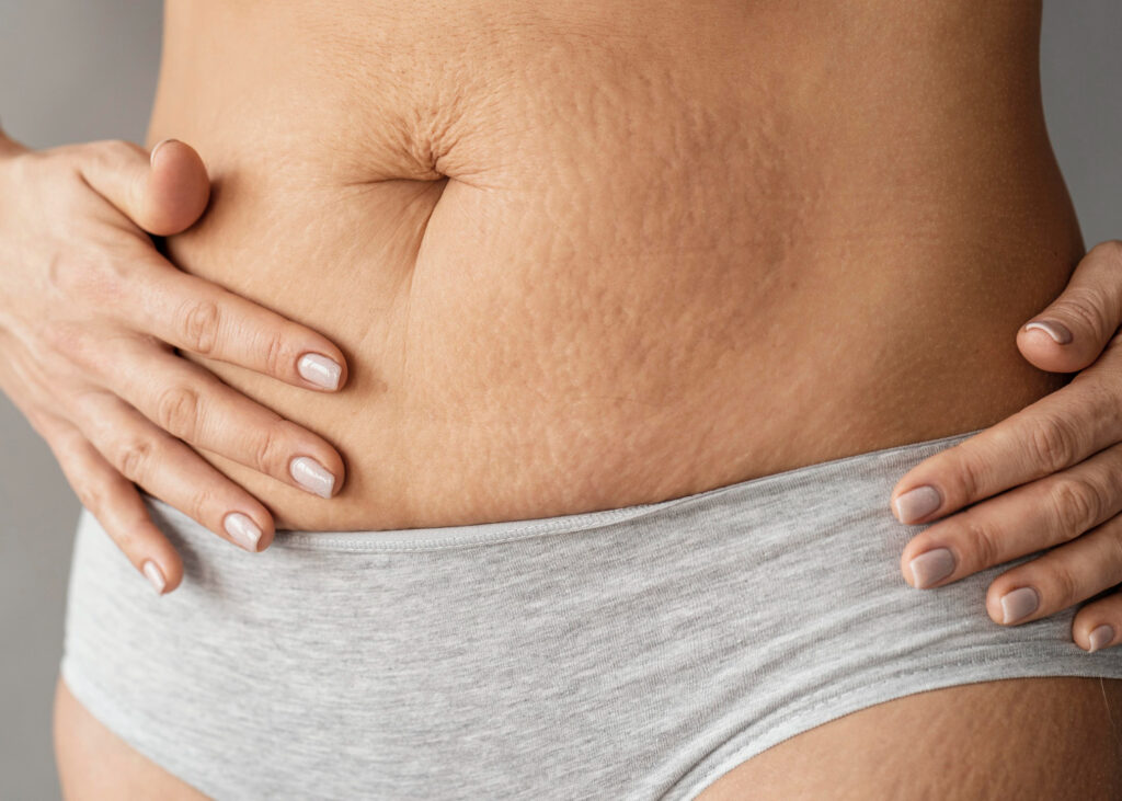 Abdomen de una persona con celulitis